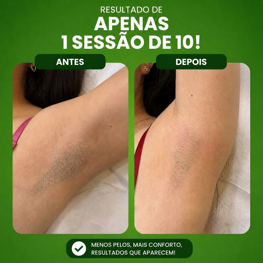 Resultado de depilação a laser após apenas 1 sessão