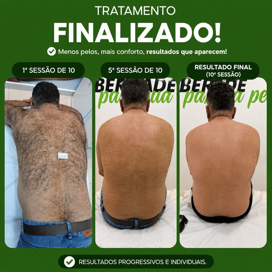 Resultado de depilação a laser - tratamento finalizado em 10 sessões